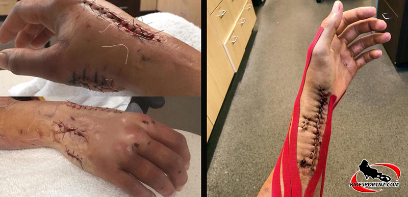 The shattered hand and arm of Ken Roczen, which happened in two separate accidents in 2007 and 2018. The injuries included the dislocation of all metacarpals and torn ligaments. His surgeon said that 99 percent of specialists would have "replaced it with a metal prosthesis right away".